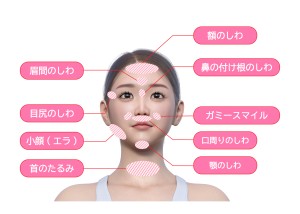 筋弛緩作用注射　ボトックス注射　ガミースマイル