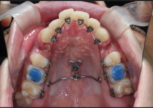 矯正　歯並び　ｱﾝｶｰｽｸﾘｭｰ　歯列矯正