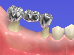 prosthesis、temporary teeth