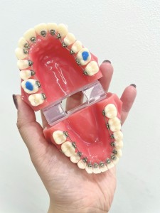 池袋　歯並び　歯列矯正　ワイヤー矯正　裏側矯正