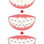 Non-extraction orthodontics　Tooth extraction orthodontics