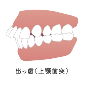 矯正歯科　歯列矯正　歯並び　ワイヤー矯正　