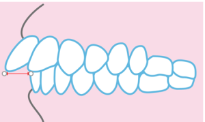 出っ歯 歯列矯正 前突