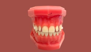 池袋　歯列矯正　歯並び　 矮小歯