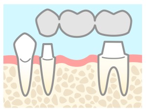 池袋　歯列矯正　歯並び　 補綴　インプラント　矯正　歯列　でこぼこ 