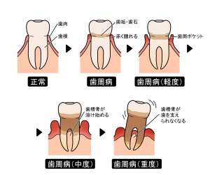 歯周病の歯