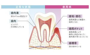 periodontal disease　tooth decay