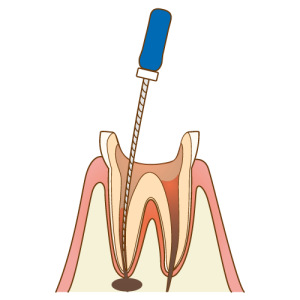 矯正歯科　根管治療　ワイヤー矯正