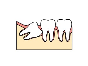 親知らず　矯正　歯並び