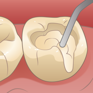 矯正歯科　虫歯　ワイヤー矯正