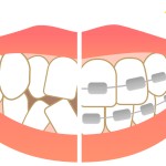 correction　row of teeth　teeth