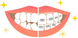 矯正治療中の痛み　歯が動く痛み