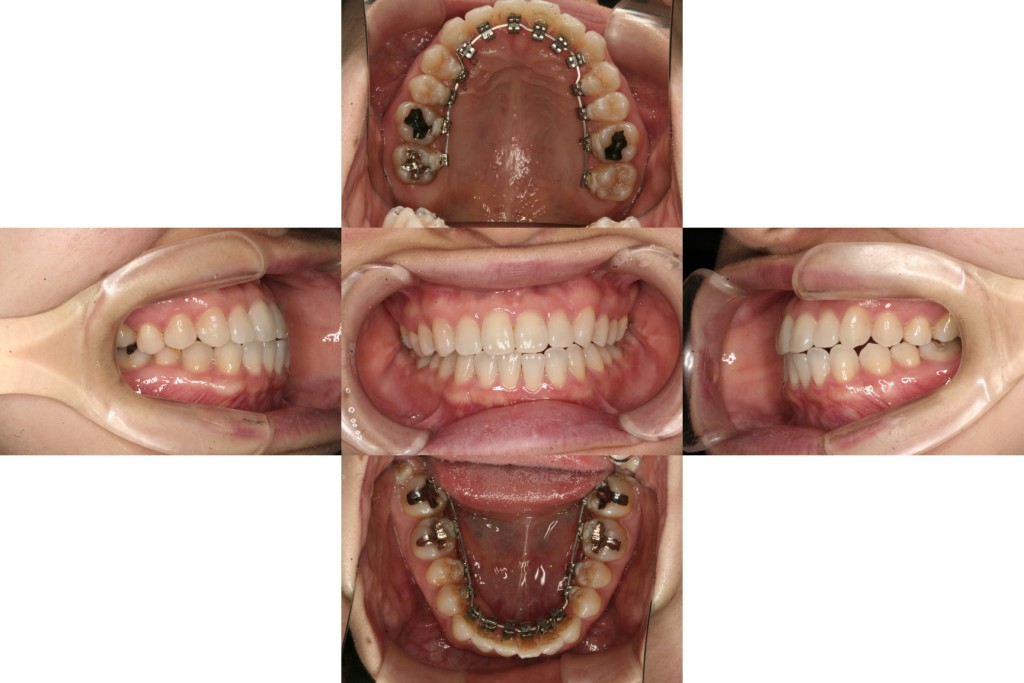 case12_軽度反対咬合_1年3ヶ月