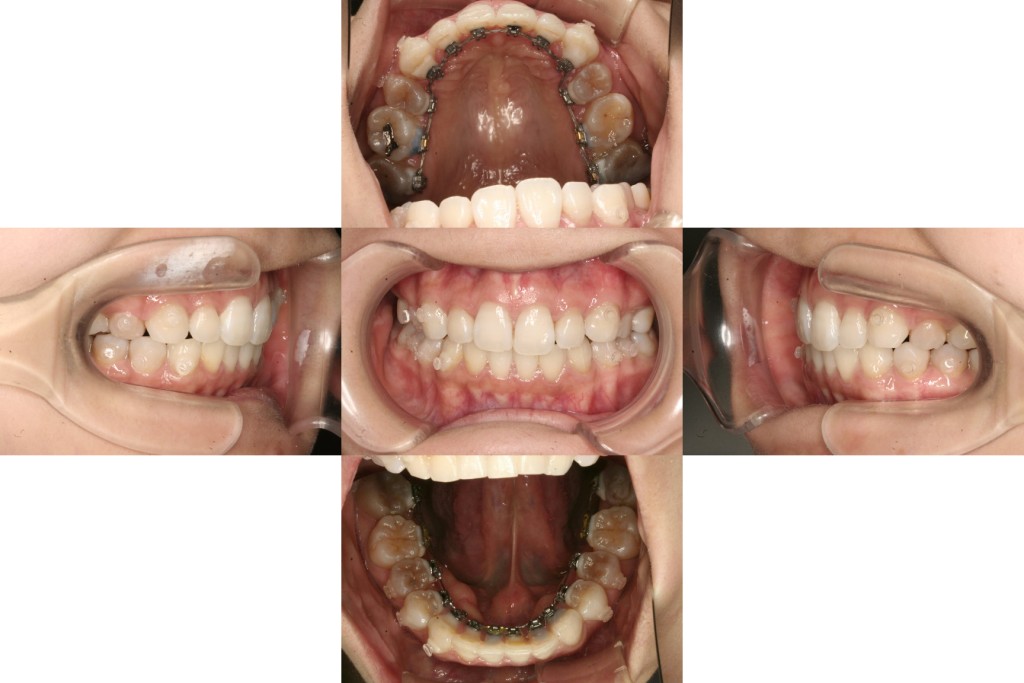 case13_軽度の出っ歯_1年半
