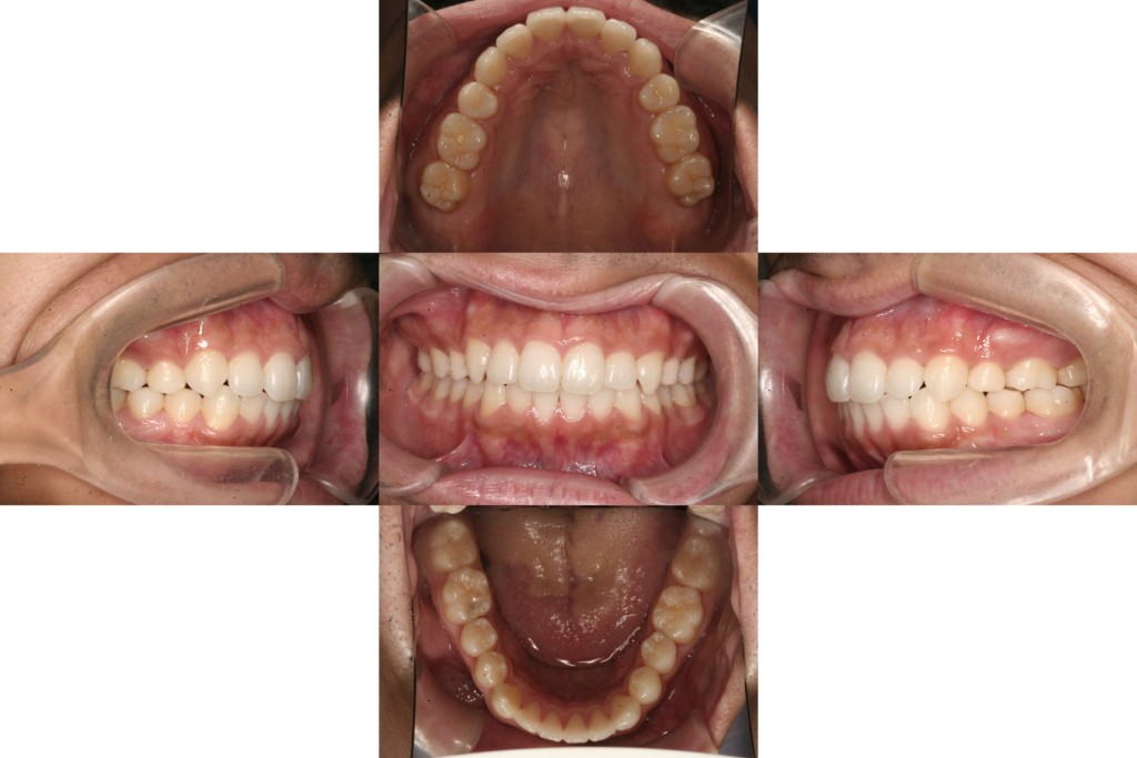 case15_出っ歯_1年半