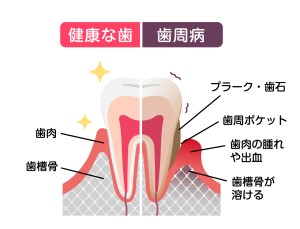 池袋　矯正　歯周病