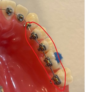 ワイヤー矯正　池袋　結紮