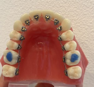 ワイヤー矯正　裏側　リンガル