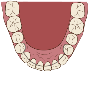 りてーなー ワイヤー