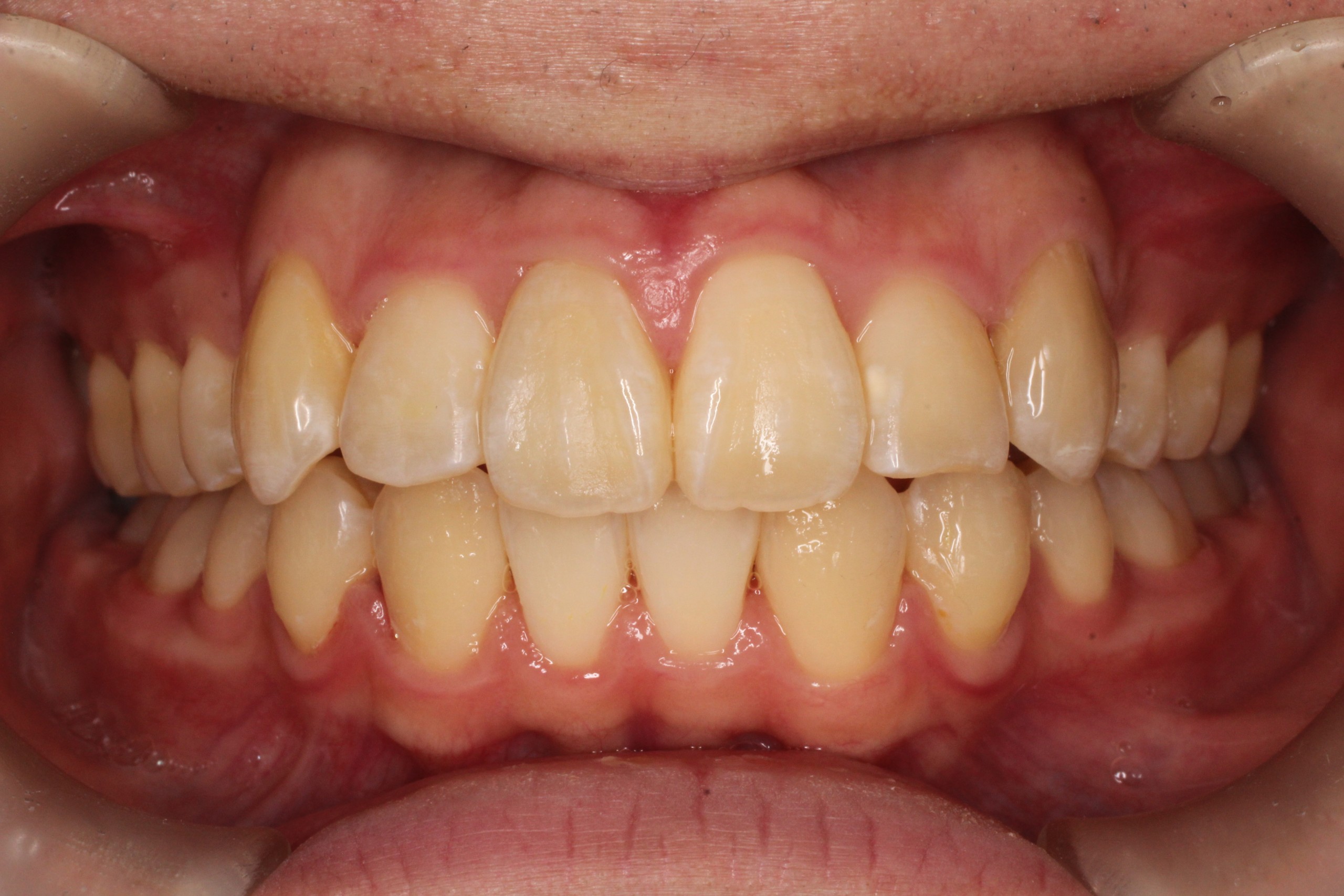 治療完了後、凸凹、叢生