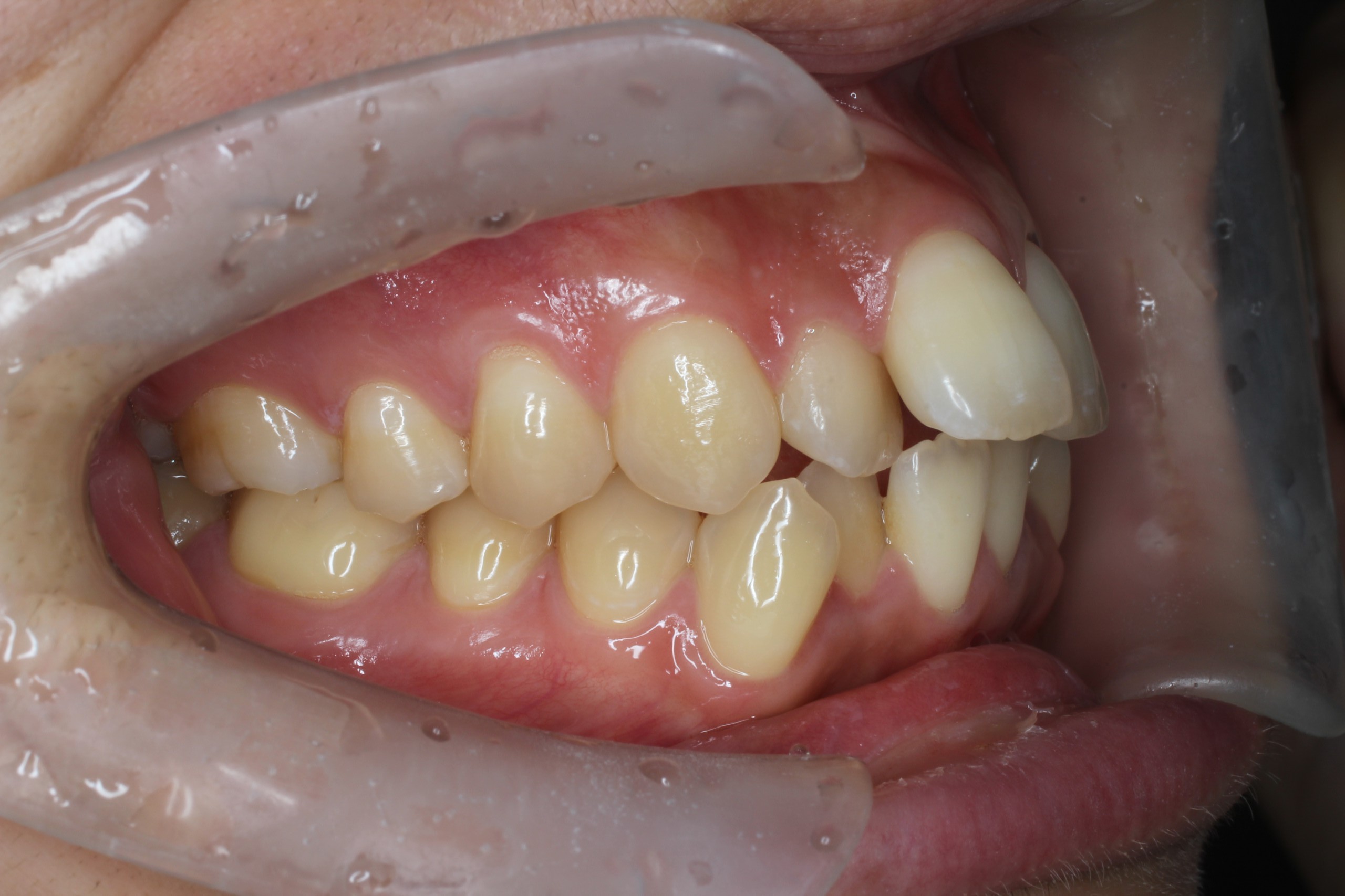 前歯の凸凹・出っ歯・裏側（リンガル）矯正