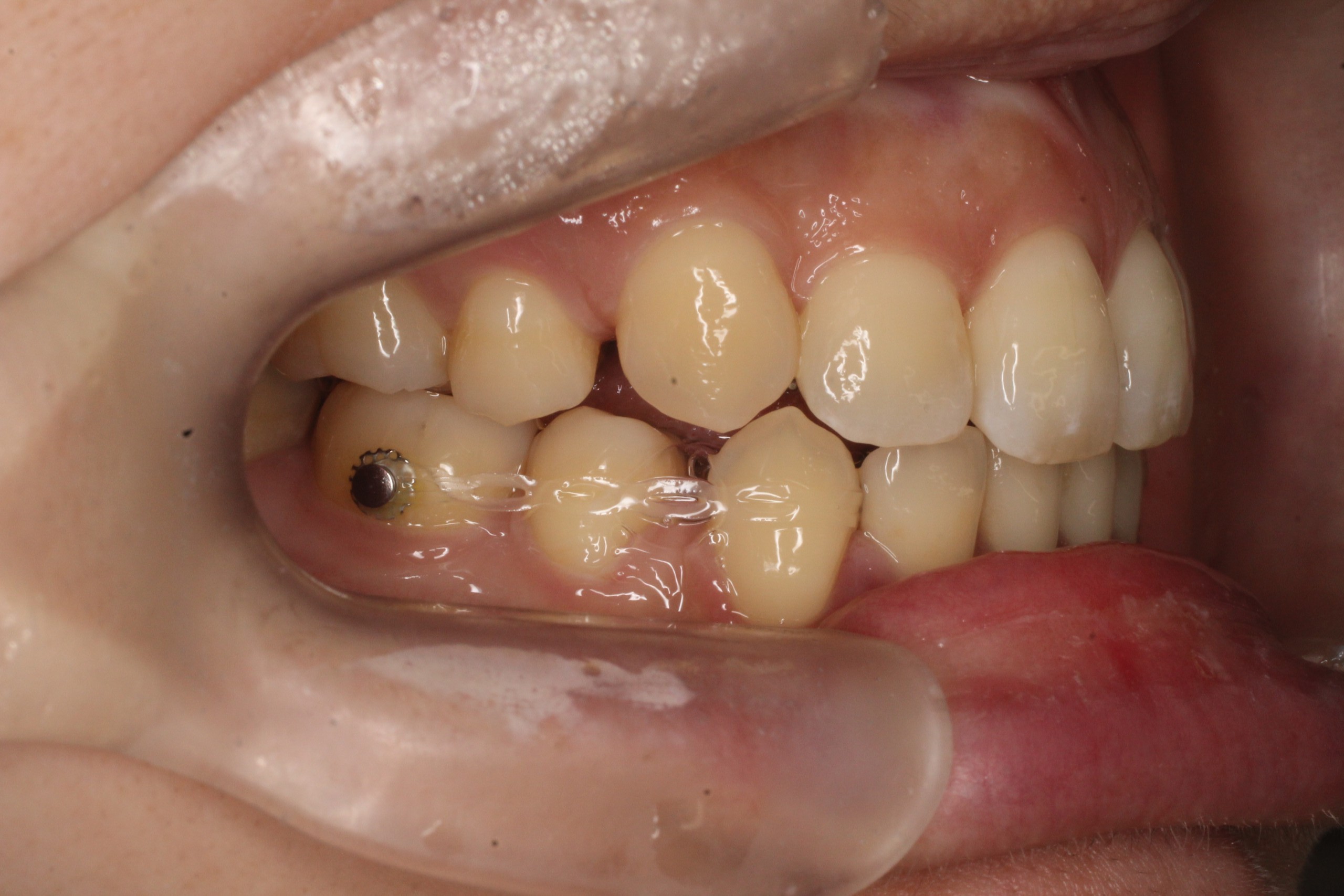 叢生改善・出っ歯改善・裏側（リンガル）矯正