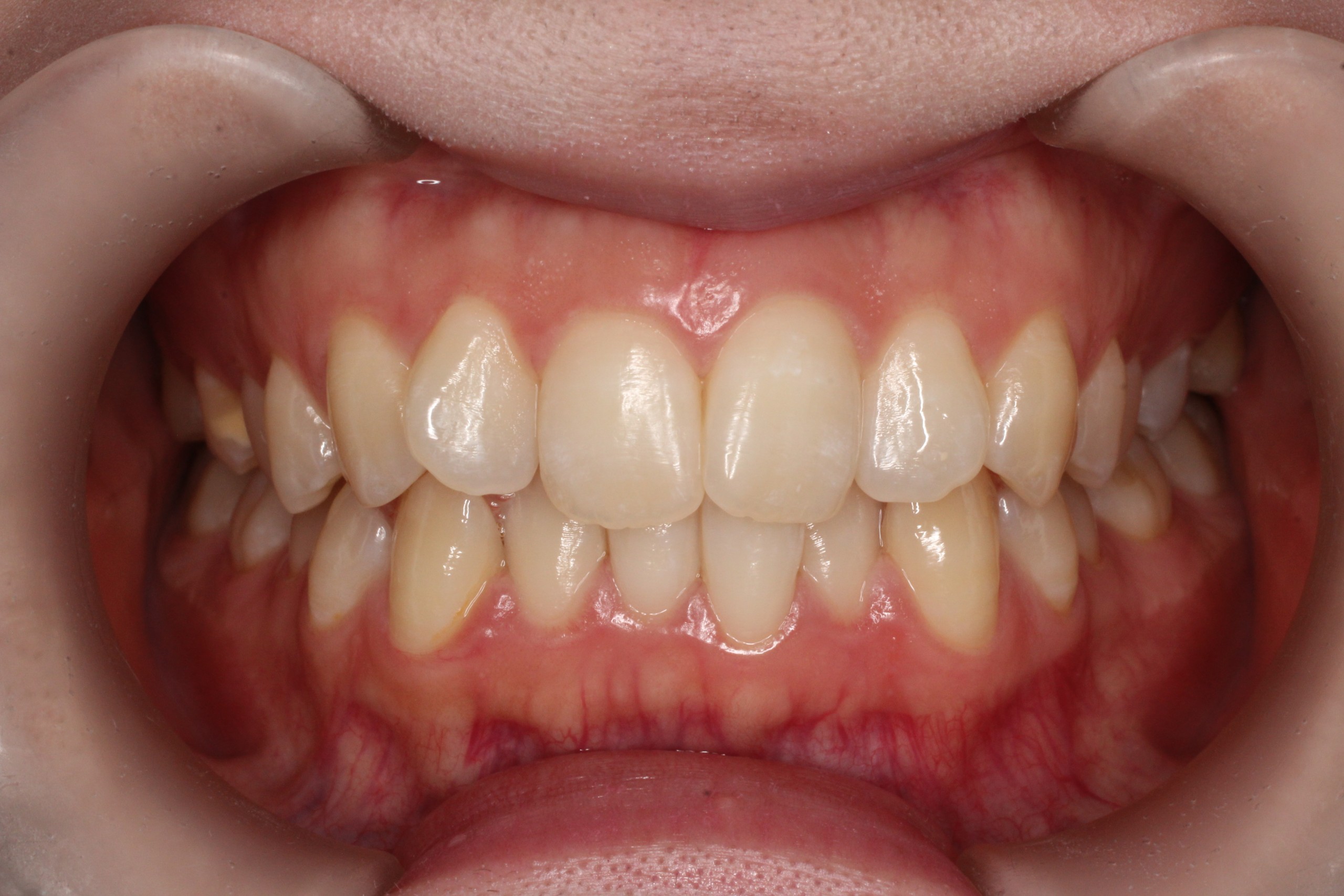 凸凹が気になる、リンガル、裏側、