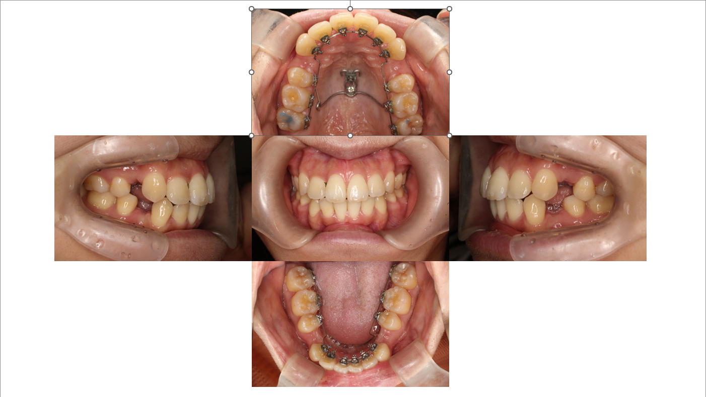 叢生・出っ歯症例