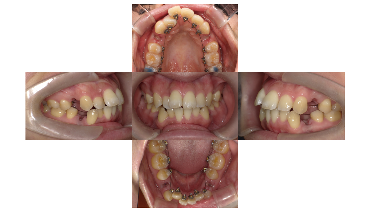 叢生・出っ歯症例