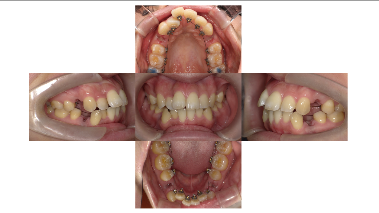 叢生・出っ歯症例