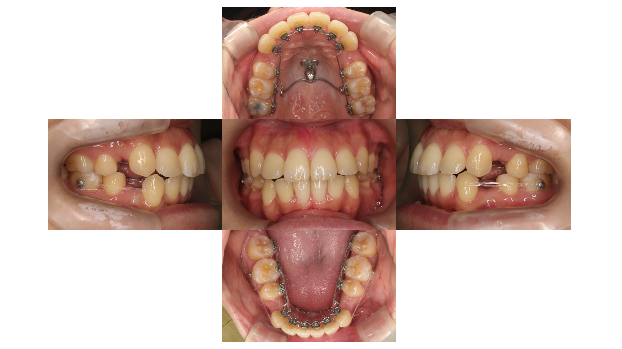 叢生・出っ歯症例
