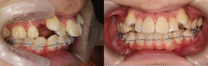 ハーフリンガル矯正、叢生、凸凹、