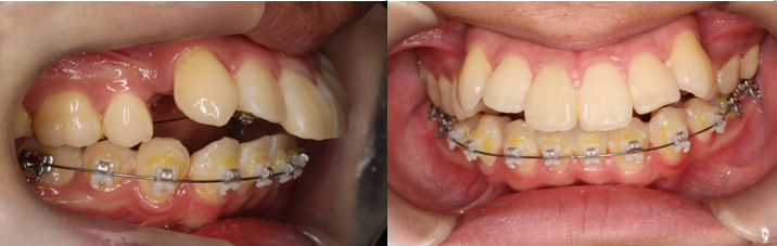 叢生、凸凹、ハーフリンガル矯正