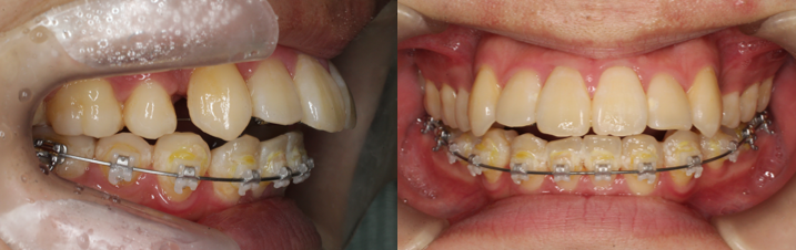 ハーフリンガル矯正、凸凹、叢生