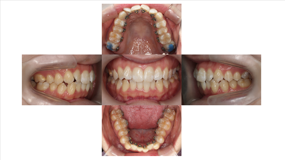 叢生、非抜歯、裏側矯正、リンガル