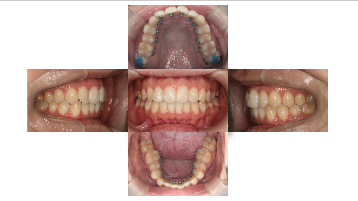 凸凹が気になる、裏側矯正、見えにくい矯正