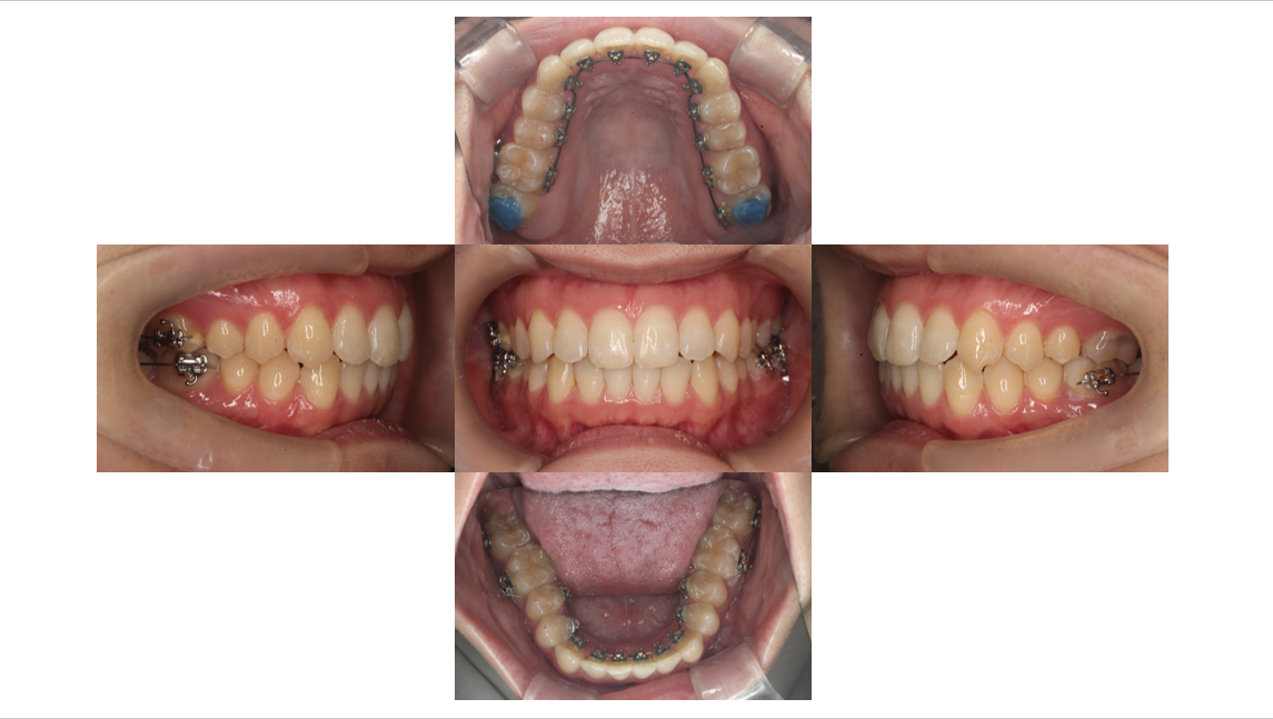 凸凹が気になる、裏側矯正、見えにくい矯正装置