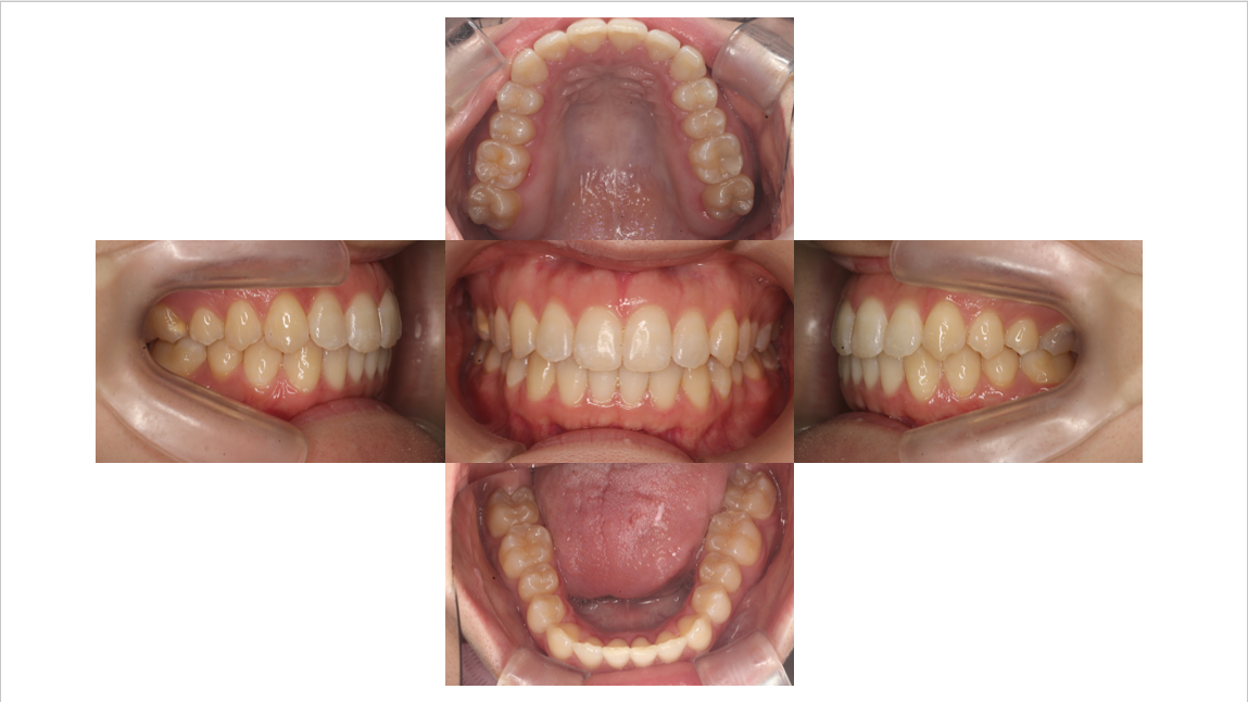 凸凹が気になる、裏側矯正、