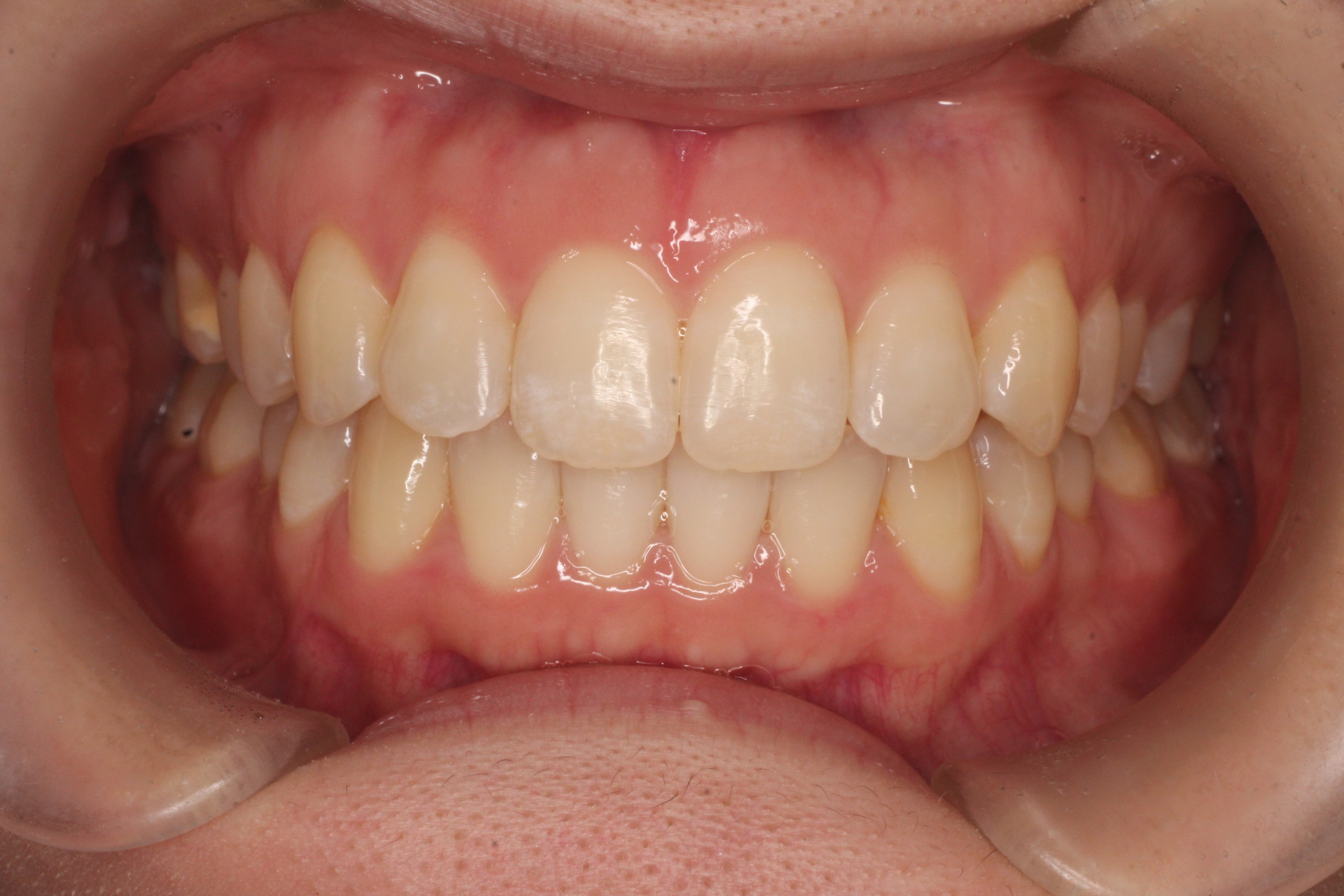 叢生、非抜歯、リンガル