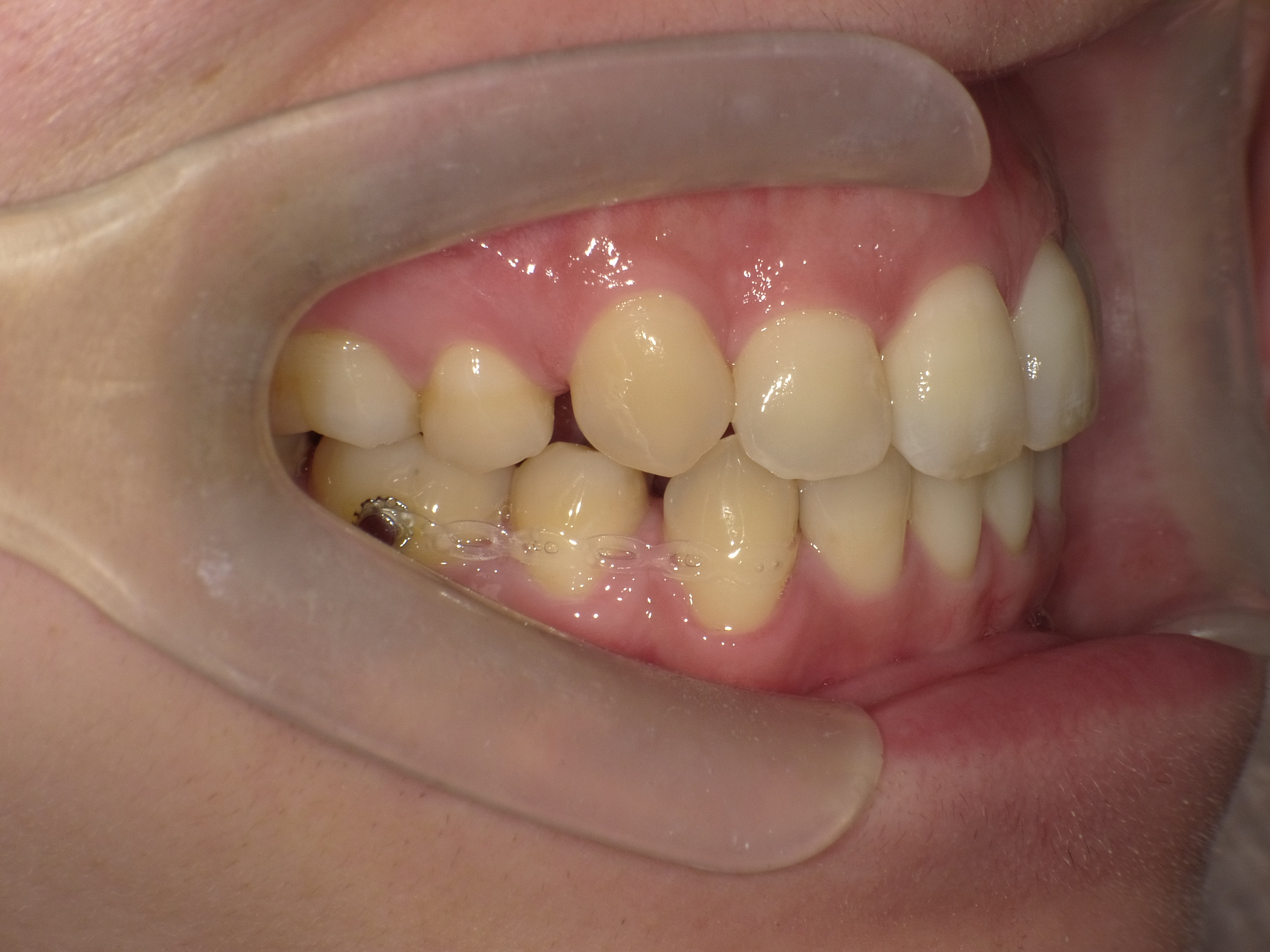 出っ歯、叢生、リンガル