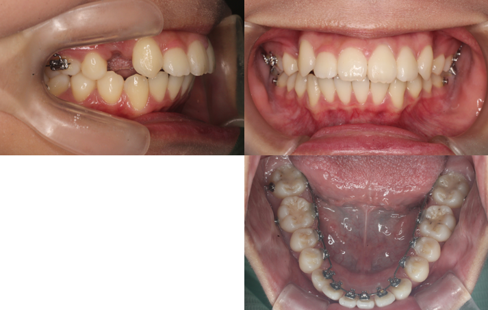 上顎前突、正中離開、リンガル
