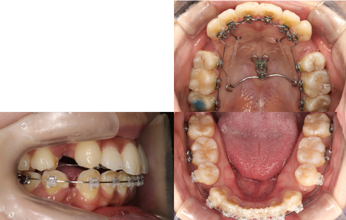 叢生、開咬、ハーフリンガル