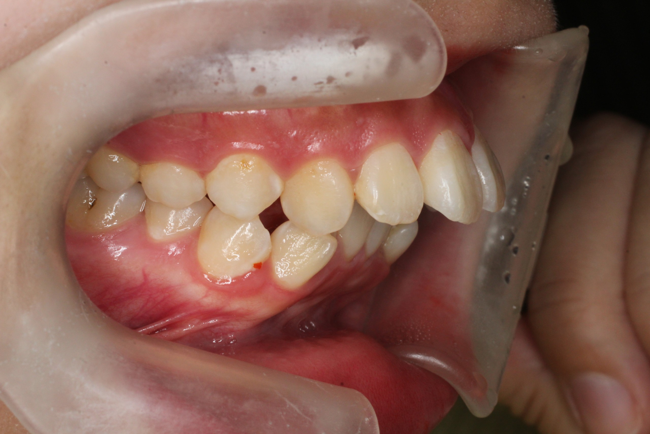 出っ歯、叢生、リンガル