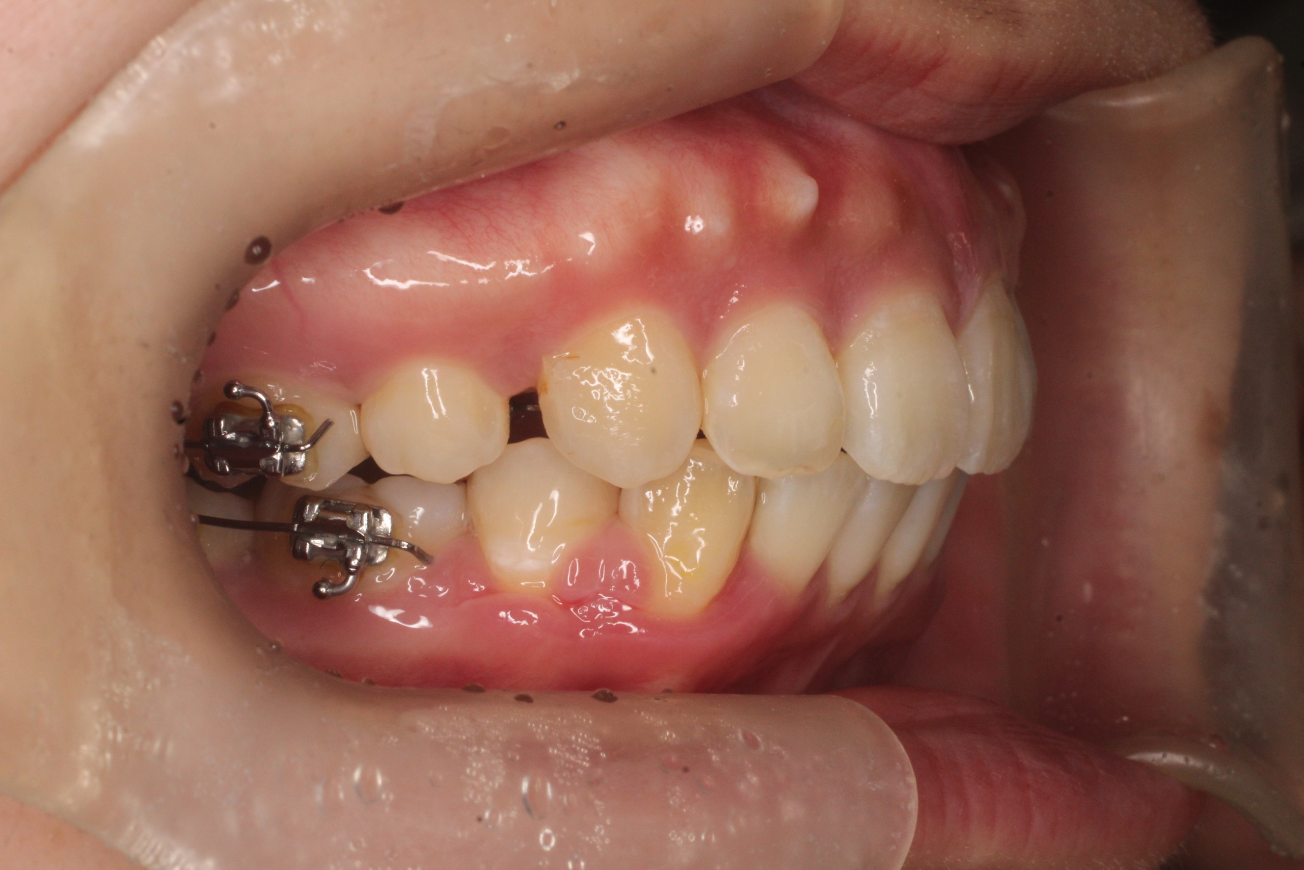 出っ歯、叢生、リンガル