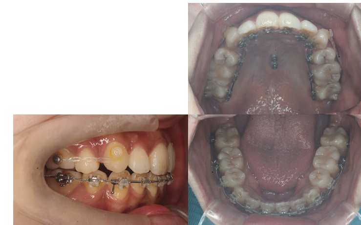 叢生、開咬、ﾊｰﾌリンガル