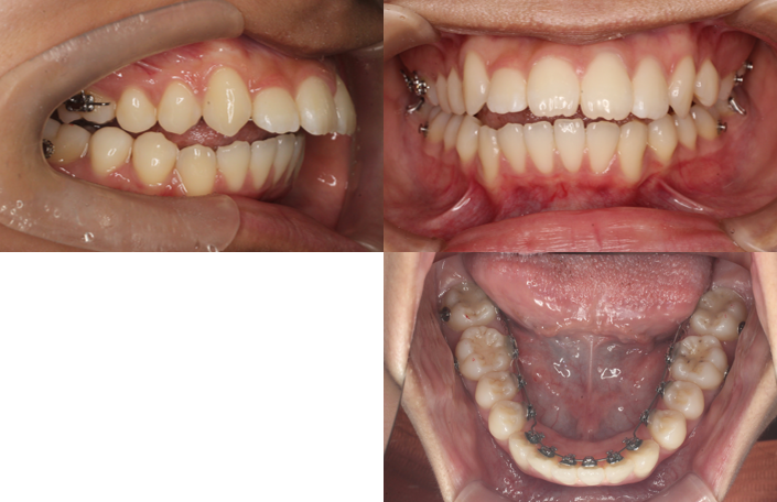 正中離開、上顎前突
、リンガル