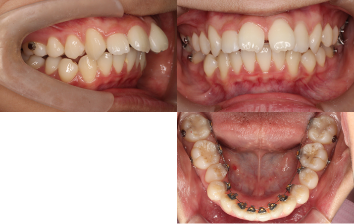 正中離開、上顎前突、リンガル