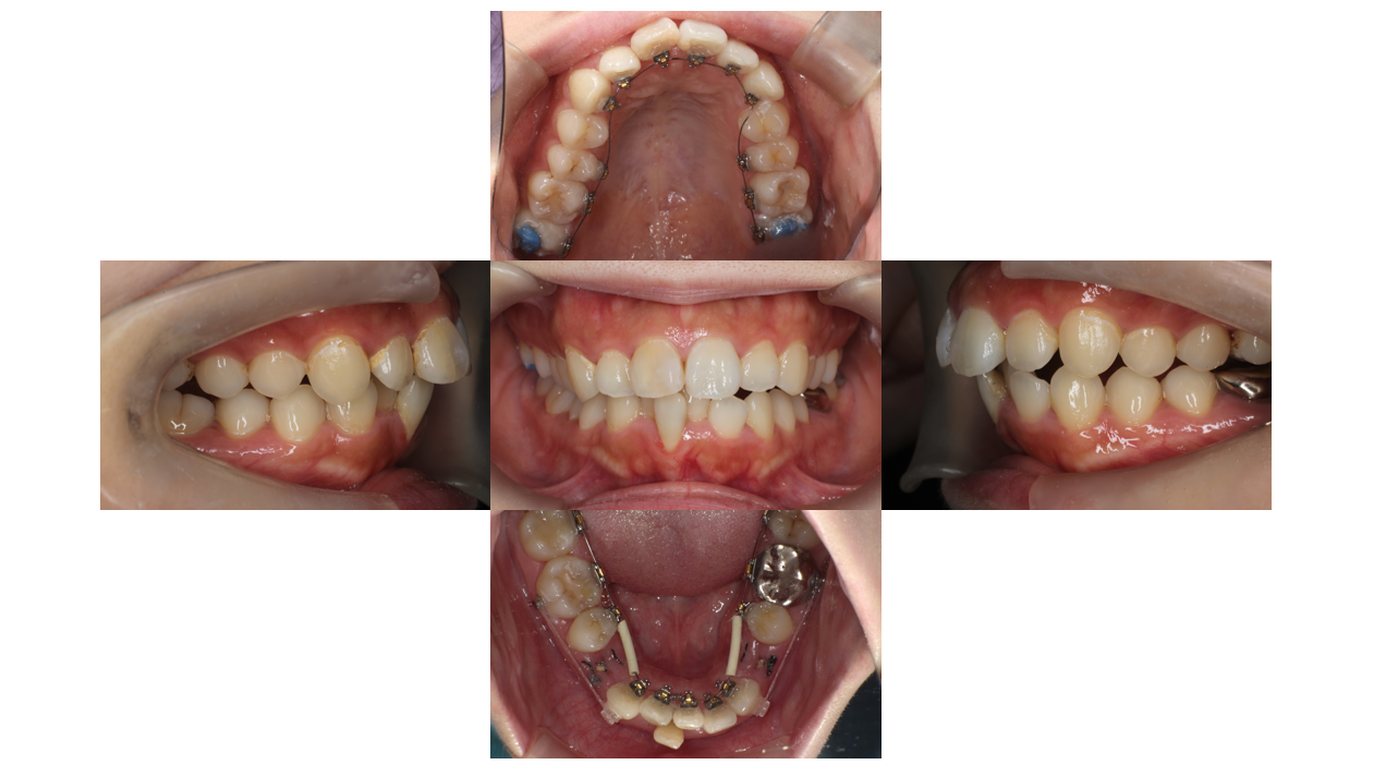 下顎叢生、リンガル
