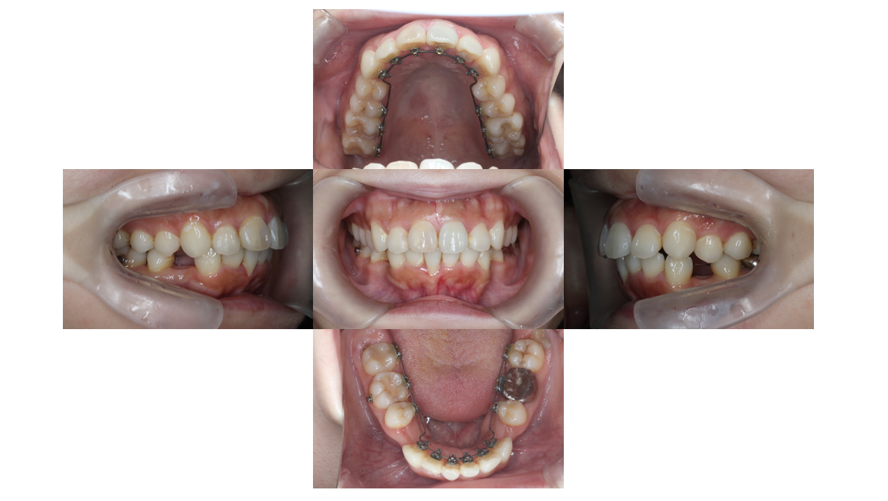 下顎叢生、リンガル 