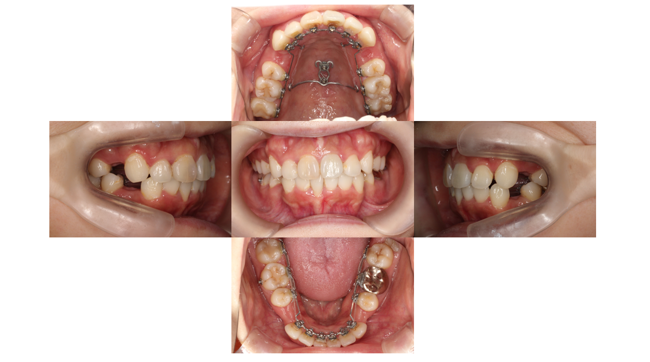 下顎叢生、リンガル 